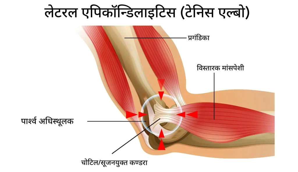 टेनिस एल्बो