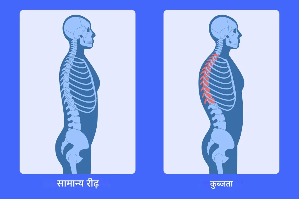 कुब्जता