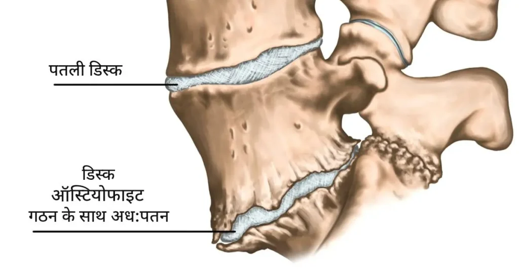 ऑस्टियोफाइट