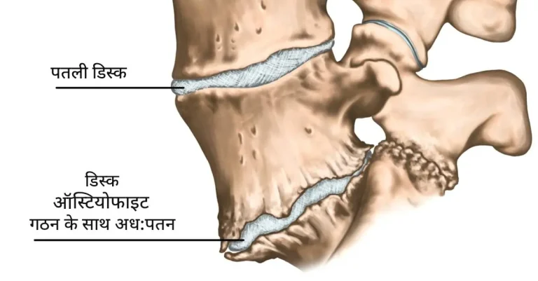 ऑस्टियोफाइट