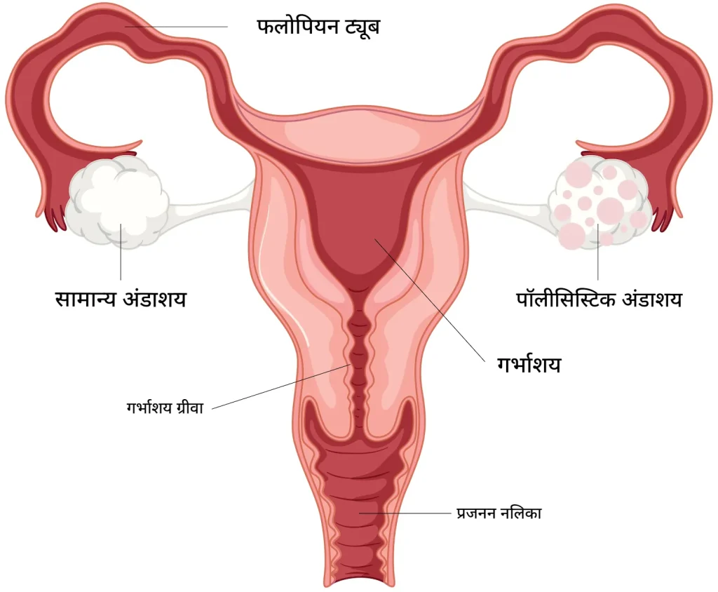 पॉलीसिस्टिक ओवरी सिंड्रोम