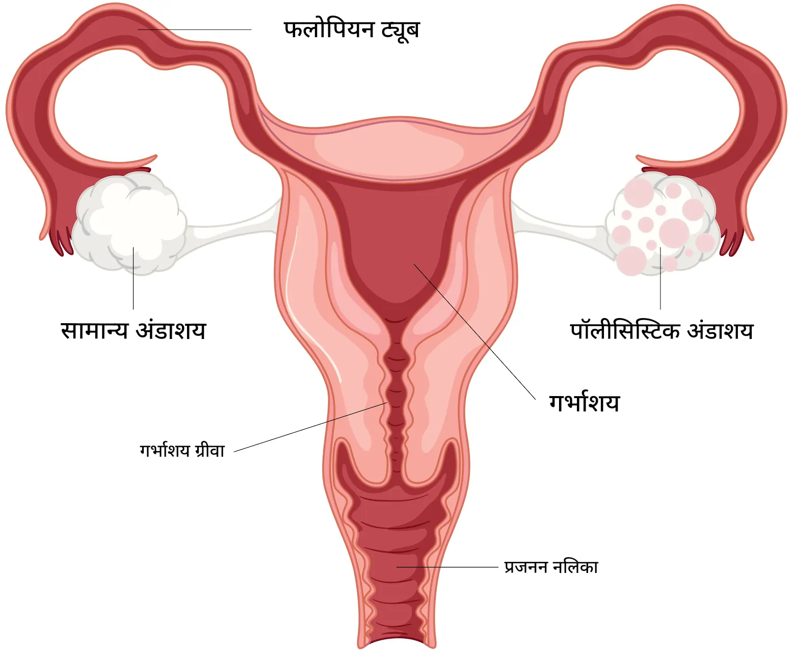 पॉलीसिस्टिक ओवरी सिंड्रोम