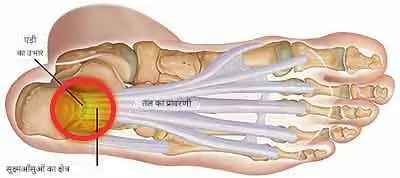 प्लांटर फैशिया