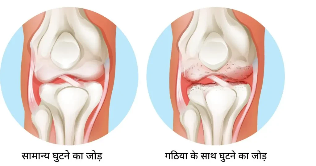 घुटनों में गैप कैसे बनाएं
