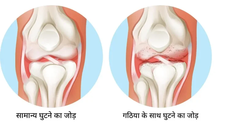 घुटनों में गैप कैसे बनाएं