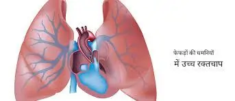 पल्मोनरी हाइपरटेंशन