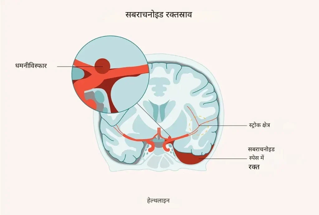 सबराचनोइड हेमरेज