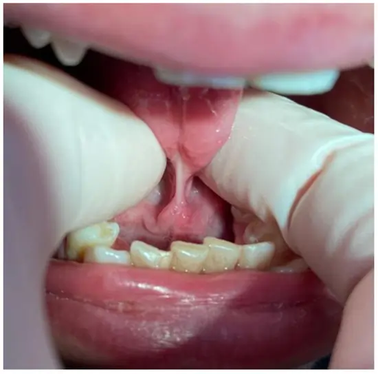 होंठ व जीभ की गतिशीलता बोली सुधार हेतु