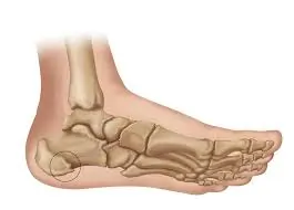 एड़ी की हड्डी बढ़ना (Calcaneal Spur): कारण और राहत