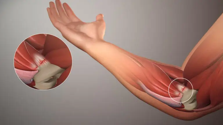 गोल्फर्स एल्बो (Golfer's Elbow) का घरेलू उपचार