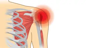 रोटेटर कफ (Rotator Cuff) की चोट: कारण और पुनर्वास