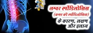 लम्बर स्पॉन्डायलोसिस
