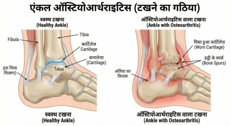 एंकल ऑस्टियोआर्थराइटिस