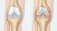 Osteoarthritis