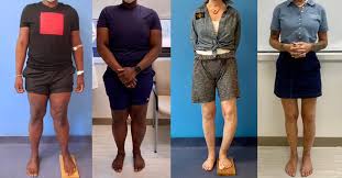 असमान पैरों की लंबाई (Leg Length Discrepancy): पीठ दर्द का यह अनदेखा कारण