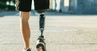 एम्प्यूटेशन (अंग कटने) के बाद प्रोस्थेटिक (कृत्रिम अंग) इस्तेमाल करने की ट्रेनिंग