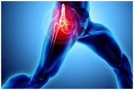 कूल्हे या जोड़ों का दर्द एक ऐसी समस्या है जो इंसान को शारीरिक और मानसिक दोनों रूपों से थका देती है। जब यह दर्द सामान्य थकान या खिंचाव का न होकर किसी गंभीर बीमारी का संकेत हो, तो सही जानकारी और समय पर इलाज बहुत जरूरी हो जाता है। ऐसी ही एक गंभीर और दर्दनाक स्थिति है— एवस्कुलर नेक्रोसिस (Avascular Necrosis या AVN), जिसे आम भाषा में 'हड्डी का गलना' या 'हड्डी का मरना' भी कहा जाता है। यह लेख विशेष रूप से कूल्हे के एवस्कुलर नेक्रोसिस (Hip AVN), इसके कारणों, लक्षणों और सबसे महत्वपूर्ण—दर्द से राहत पाने के प्रभावी उपायों पर केंद्रित है। एवस्कुलर नेक्रोसिस (AVN) क्या है? हमारे शरीर की हर जीवित कोशिका और ऊतक (Tissue) को जीवित रहने के लिए ऑक्सीजन और पोषक तत्वों की आवश्यकता होती है, जो रक्त (Blood) के माध्यम से उन तक पहुंचते हैं। हमारी हड्डियां भी जीवित ऊतक हैं। 'एवस्कुलर' (Avascular) का अर्थ है रक्त की आपूर्ति का अभाव और 'नेक्रोसिस' (Necrosis) का अर्थ है ऊतकों की मृत्यु। जब कूल्हे की हड्डी (विशेष रूप से जांघ की हड्डी के ऊपरी हिस्से जिसे 'फीमर का सिर' या Femoral Head कहते हैं) को रक्त की आपूर्ति किसी कारणवश कम हो जाती है या रुक जाती है, तो हड्डी की कोशिकाएं मरने लगती हैं। धीरे-धीरे हड्डी कमजोर होने लगती है और अंततः वह टूट कर गिर सकती है (Collapse)। जब फीमर का सिर अपना आकार खो देता है, तो कूल्हे के जोड़ (Ball and Socket Joint) का अलाइनमेंट बिगड़ जाता है, जिससे गंभीर आर्थराइटिस (Arthritis) विकसित हो जाता है और असहनीय दर्द होता है। कूल्हे में AVN के मुख्य कारण रक्त प्रवाह बाधित होने के कई कारण हो सकते हैं। कुछ मुख्य जोखिम कारक निम्नलिखित हैं: चोट या आघात (Trauma): कूल्हे का डिसलोकेशन (खिसकना) या फीमर की हड्डी में फ्रैक्चर होने से आसपास की रक्त वाहिकाएं (Blood vessels) क्षतिग्रस्त हो सकती हैं। कॉर्टिकोस्टेरॉइड्स का अत्यधिक उपयोग: लंबे समय तक या भारी मात्रा में स्टेरॉयड (जैसे प्रेडनिसोन) का उपयोग AVN का एक बहुत बड़ा कारण है। कई बार अस्थमा, गठिया या कोविड-19 जैसी बीमारियों के इलाज में जीवन रक्षक के रूप में इनका उपयोग किया जाता है, लेकिन इसके दुष्प्रभाव के रूप में AVN हो सकता है। शराब का अत्यधिक सेवन: बहुत अधिक शराब पीने से रक्त वाहिकाओं में फैट (वसा) जमा होने लगता है, जिससे रक्त प्रवाह का रास्ता संकरा हो जाता है और हड्डियों तक पर्याप्त खून नहीं पहुंच पाता। चिकित्सीय स्थितियां: सिकल सेल एनीमिया, गौचर रोग (Gaucher's disease), ल्यूपस और एचआईवी जैसी बीमारियां भी रक्त के थक्के जमने या रक्त प्रवाह में बाधा उत्पन्न करने का कारण बन सकती हैं। रेडिएशन थेरेपी: कैंसर के इलाज के लिए दी जाने वाली रेडिएशन थेरेपी भी हड्डियों और रक्त वाहिकाओं को कमजोर कर सकती है। बीमारी के लक्षण: शरीर क्या संकेत देता है? AVN के शुरुआती चरणों में अक्सर कोई लक्षण दिखाई नहीं देते हैं। जैसे-जैसे बीमारी बढ़ती है, दर्द और तकलीफ बढ़ने लगती है: शुरुआती दर्द: जांघ के जोड़ (Groin), कूल्हे के किनारे या नितंब (Buttocks) में हल्का दर्द शुरू होता है। शुरुआत में यह दर्द केवल वजन डालने या चलने-फिरने पर होता है। दर्द का बढ़ना: समय के साथ दर्द घुटने तक फैल सकता है और आराम करते समय या रात में सोते समय भी दर्द महसूस होने लगता है। गतिशीलता में कमी: कूल्हे को मोड़ने या घुमाने में मुश्किल होती है। रोजमर्रा के काम जैसे सीढ़ियां चढ़ना, जमीन पर बैठना, या मोज़े पहनना चुनौतीपूर्ण हो जाता है। लंगड़ापन: हड्डी के आकार में बदलाव और दर्द के कारण व्यक्ति लंगड़ा कर चलने लगता है। दर्द से राहत और गैर-सर्जिकल उपचार (Non-Surgical Pain Management) यदि AVN का निदान (Diagnosis) शुरुआती चरण (स्टेज 1 या 2) में हो जाता है, तो मुख्य लक्ष्य दर्द को कम करना, हड्डी को और अधिक नष्ट होने से रोकना और जोड़ की कार्यक्षमता बनाए रखना होता है। इसके लिए निम्नलिखित उपाय अपनाए जाते हैं: 1. दवाओं के माध्यम से दर्द नियंत्रण (Medications) NSAIDs (नॉन-स्टेरायडल एंटी-इंफ्लेमेटरी ड्रग्स): इबुप्रोफेन, नेप्रोक्सन या डिक्लोफेनाक जैसी दवाएं दर्द और सूजन को कम करने में काफी मददगार होती हैं। (ध्यान दें: डॉक्टर की सलाह के बिना इनका लंबे समय तक उपयोग न करें)। ऑस्टियोपोरोसिस की दवाएं: कुछ दवाएं (जैसे एलेनड्रोनेट) हड्डी के टूटने की प्रक्रिया को धीमा कर सकती हैं। कोलेस्ट्रॉल कम करने वाली दवाएं (Statins): यदि रक्त वाहिकाओं में फैट जमने के कारण रुकावट है, तो स्टैटिन दवाएं उस फैट को साफ करने में मदद कर सकती हैं। रक्त पतला करने वाली दवाएं (Blood Thinners): यदि मरीज को रक्त के थक्के जमने की समस्या है, तो ये दवाएं दी जाती हैं ताकि रक्त प्रवाह सुचारू हो सके। 2. कूल्हे को आराम और सहायक उपकरणों का उपयोग (Rest & Assistive Devices) दर्द का सबसे बड़ा कारण डैमेज हो चुकी हड्डी पर शरीर का वजन पड़ना है। वजन कम डालना: डॉक्टर कुछ समय के लिए कूल्हे पर वजन कम डालने की सलाह देते हैं। बैसाखी (Crutches) या वॉकर का उपयोग: चलने के लिए बैसाखी या वॉकर का उपयोग करने से कूल्हे के जोड़ पर दबाव कम होता है, जिससे दर्द में तुरंत राहत मिलती है और हड्डी को हील होने का थोड़ा समय मिलता है। 3. फिजिकल थेरेपी और व्यायाम (Physical Therapy) एक योग्य फिजियोथेरेपिस्ट के मार्गदर्शन में व्यायाम करना दर्द प्रबंधन का एक अहम हिस्सा है। स्ट्रेचिंग (Stretching): कूल्हे के आसपास की मांसपेशियों (जैसे हिप फ्लेक्सर्स और ग्लूट्स) को स्ट्रेच करने से जकड़न कम होती है। स्ट्रेंथनिंग (Strengthening): कूल्हे को सहारा देने वाली मांसपेशियों को मजबूत करने वाले व्यायाम जोड़ पर पड़ने वाले भार को कम करते हैं। वाटर एरोबिक्स (Water Aerobics): पानी के अंदर व्यायाम करना (हाइड्रोथेरेपी) सबसे बेहतरीन है क्योंकि पानी के उछाल (Buoyancy) के कारण कूल्हे पर शरीर का वजन नहीं पड़ता और जोड़ की मूवमेंट भी हो जाती है। 4. गर्म और ठंडी सिकाई (Hot and Cold Compress) सूजन और तेज दर्द होने पर आइस पैक (ठंडी सिकाई) का उपयोग करें। यह नसों को सुन्न कर देता है और सूजन कम करता है। मांसपेशियों में ऐंठन और जकड़न को कम करने के लिए गर्म सिकाई (हीटिंग पैड) का उपयोग किया जा सकता है। यह उस हिस्से में रक्त प्रवाह को भी कुछ हद तक बढ़ाता है। आहार और जीवनशैली में बदलाव (Lifestyle & Diet) दवाओं के साथ-साथ आपकी जीवनशैली भी दर्द से राहत दिलाने में अहम भूमिका निभाती है: वजन नियंत्रण: शरीर का अतिरिक्त वजन सीधे कूल्हे के जोड़ों पर पड़ता है। वजन कम करने से दर्द में चमत्कारी रूप से कमी आ सकती है। शराब और धूम्रपान छोड़ें: ये दोनों ही रक्त प्रवाह को बाधित करते हैं और हड्डी के गलने की प्रक्रिया को तेज करते हैं। दर्द से राहत और बीमारी को रोकने के लिए इनका त्याग अत्यंत आवश्यक है। कैल्शियम और विटामिन D: हड्डियों की सामान्य मजबूती के लिए अपने आहार में दूध, दही, पनीर, हरी पत्तेदार सब्जियां और विटामिन D सप्लीमेंट्स शामिल करें। एंटी-इंफ्लेमेटरी आहार: ओमेगा-3 फैटी एसिड (अखरोट, अलसी के बीज), हल्दी, और अदरक का सेवन शरीर की प्राकृतिक सूजन को कम करने में मदद करता है। सर्जिकल विकल्प: जब अन्य उपाय काम न आएं AVN एक प्रगतिशील (Progressive) बीमारी है। यदि बीमारी स्टेज 3 या 4 में पहुंच चुकी है, हड्डी का आकार पिचक गया है और दर्द असहनीय हो गया है, तो सर्जरी ही एकमात्र स्थायी उपाय बचता है। दर्द से राहत दिलाने वाली प्रमुख सर्जरियां निम्नलिखित हैं: 1. कोर डिकम्प्रेशन (Core Decompression): यह शुरुआती चरणों (स्टेज 1 और 2) के लिए बहुत कारगर है। इसमें सर्जन हड्डी के अंदर दबाव को कम करने और नई रक्त वाहिकाओं के विकास के लिए जगह बनाने के लिए फीमर के सिर (हड्डी) में एक छेद (ड्रिल) करता है। इससे दर्द में बहुत राहत मिलती है और बीमारी का बढ़ना धीमा हो जाता है। 2. बोन ग्राफ्टिंग (Bone Grafting): अक्सर कोर डिकम्प्रेशन के साथ, शरीर के दूसरे हिस्से (जैसे पैर की हड्डी) से स्वस्थ हड्डी का एक टुकड़ा निकालकर कूल्हे की क्षतिग्रस्त हड्डी की जगह लगाया जाता है। इससे हड्डी को सहारा मिलता है और रक्त प्रवाह में सुधार होता है। 3. टोटल हिप रिप्लेसमेंट (Total Hip Replacement - THR): जब फीमर का सिर पूरी तरह से ढह (Collapse) जाता है और गंभीर आर्थराइटिस हो जाता है, तो यह अंतिम और सबसे सफल विकल्प है। इस सर्जरी में क्षतिग्रस्त हड्डी और कार्टिलेज को हटाकर कृत्रिम (Artificial) धातु या प्लास्टिक के जोड़ (Implants) लगा दिए जाते हैं। दर्द से पूर्ण राहत: यह सर्जरी दर्द को पूरी तरह से खत्म कर देती है और मरीज फिर से अपनी सामान्य जिंदगी जी सकता है। निष्कर्ष कूल्हे का एवस्कुलर नेक्रोसिस (AVN) एक गंभीर स्थिति है, लेकिन आधुनिक चिकित्सा विज्ञान में इसका बहुत प्रभावी इलाज उपलब्ध है। यदि आपको जांघ या कूल्हे में लगातार दर्द हो रहा है, जो आराम करने पर भी ठीक नहीं हो रहा है, तो इसे नजरअंदाज न करें। शुरुआती निदान (Early Diagnosis) से आप बड़ी सर्जरी से बच सकते हैं और सामान्य जीवन जी सकते हैं।