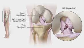 एसीएल टियर (ACL Tear)