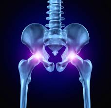 कूल्हा बदलने (Total Hip Replacement) के बाद कौन सी गलतियां बिल्कुल न करें?