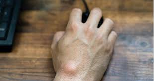 गैंग्लियन सिस्ट (Ganglion Cyst): कलाई पर बनने वाली गांठ का इलाज