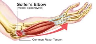 गोल्फर एल्बो (Golfer’s Elbow)