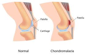 घुटने की गद्दी फटने (Chondromalacia Patella) के बाद सुरक्षित व्यायाम