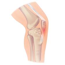 जंपर्स नी (Patellar Tendinitis): वॉलीबॉल और बास्केटबॉल खिलाड़ियों के घुटने का इलाज