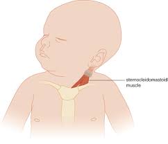टोर्टिकॉलिस (Torticollis): नवजात शिशु की गर्दन एक तरफ झुकी होने का इलाज