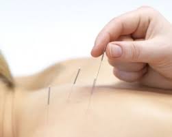 ड्राई नीडलिंग (Dry Needling): मांसपेशियों की गांठ (Trigger Points) को खोलने की तकनीक