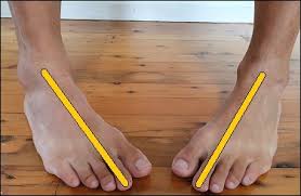 पिजन टोज़ (Pigeon Toes): चलते समय पंजों का अंदर की तरफ मुड़ने का कारण