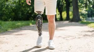 प्रोस्थेटिक ट्रेनिंग (Prosthetic Training): नकली पैर लगने के बाद चलना कैसे सीखें?