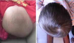 बच्चों में फ्लैट हेड सिंड्रोम (Flat Head Syndrome) को रोकने के लिए टमी टाइम (Tummy Time)