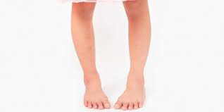 बो लेग्स (Bow Legs): पैरों के बाहर की तरफ मुड़ने का फिजियोथेरेपी उपचार