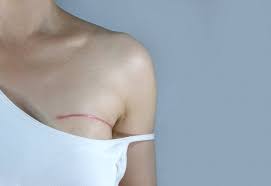 ब्रेस्ट सर्जरी (Mastectomy) के बाद कंधे की जकड़न को दूर करने के व्यायाम