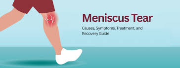 मेनिस्कस टियर (Meniscus Tear): लक्षण, कारण और बिना सर्जरी के उपचार