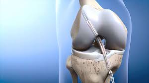 लिगामेंट सर्जरी (ACL Reconstruction) के बाद कितने दिन में वापस खेल शुरू कर सकते हैं?