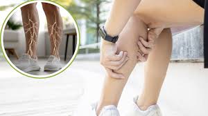 विटामिन बी12 की कमी और नसों में झुनझुनी: फिजियोथेरेपी के साथ डाइट का रोल