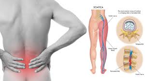 सायटिका (Sciatica) का दर्द: कमर से पैर तक जाने वाले सुन्नपन का इलाज