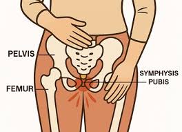 सिम्फिसिस-प्यूबिस-डिसफंक्शन-SPD-प्रेगनेंसी-में-पेल्विक-हड्डी-के-तेज-दर्द-का-उपाय