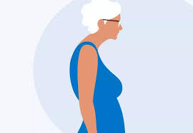 सिलाई और बुनाई (Knitting) करने वाली महिलाओं में गर्दन के पीछे कुबड़ (Dowager's Hump)