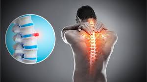 स्लिप्ड डिस्क (Slipped Disc के लिए सबसे सुरक्षित और असरदार एक्सरसाइज