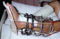 इलिजारोव (Ilizarov) फिक्सेटर (रिंग वाला प्लास्टर) लगे मरीजों की केयर और फिजियोथेरेपी