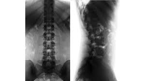 एंकिलॉजिंग स्पॉन्डिलाइटिस (AS): सुबह की भयंकर अकड़न (Bamboo Spine) को कम करने के स्ट्रेच