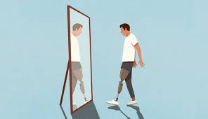 एम्प्यूटेशन (अंग विच्छेदन) के बाद फैंटम लिंब पेन (Phantom Limb Pain) और प्रोस्थेटिक ट्रेनिंग