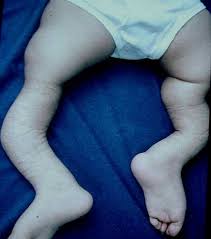 ऑस्टियोजेनेसिस इम्पर्फेक्टा (Brittle Bone Disease) वाले बच्चों की सुरक्षित फिजियोथेरेपी