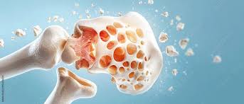 ऑस्टियोपोरोसिस की दवाओं (जैसे Bisphosphonates) के साथ वेट-बियरिंग व्यायाम का तालमेल कैसे बिठाएं?