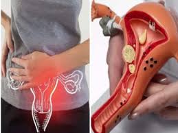 किशोर लड़कियों में पीसीओएस (PCOS) के कारण बढ़ने वाले वजन और जोड़ों के दर्द का फिजियोथेरेपी नियंत्रण