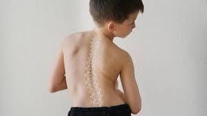 किशोरों में स्कोलियोसिस (रीढ़ की हड्डी का टेढ़ापन): शुरुआती पहचान और स्क्रोथ (Schroth) व्यायाम