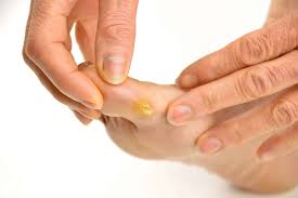 कॉर्न (Corns) और कैलस (Calluses): टाइट जूतों के कारण पैरों में पड़ने वाले कड़े गट्टे और उनका एर्गोनॉमिक बचाव