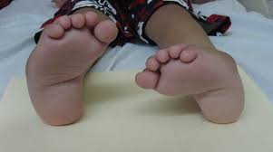 क्लबफुट (टेढ़े पैर) का बिना सर्जरी के इलाज: फिजियोथेरेपी और पोंसेटी मेथड (Ponseti Method)